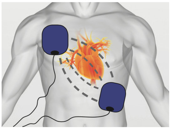 Choc électrique externe programme  Société Française de Cardiologie