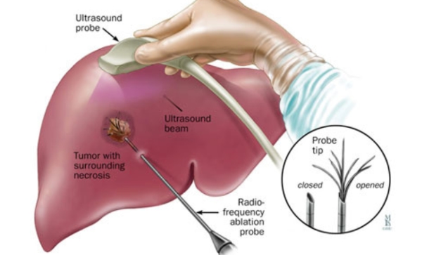 Chirurgie du Foie | CHL