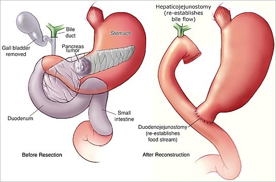 Chirurgie du Pancréas | CHL