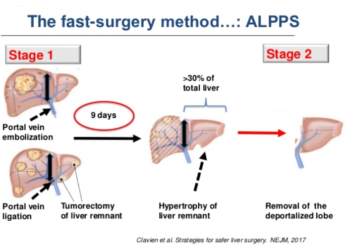 Hépatectomie : chirurgie du foie