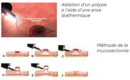 Ablation d’un polype à l’aide d’une anse diathermique et Méthode de la mucosectomie