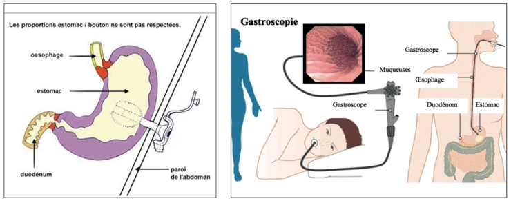 Schémas techniques d'une gastroscopie