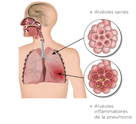 La pneumonie | CHL