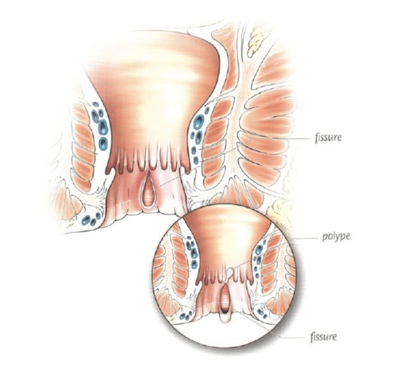 Les pathologies coloproctologiques | CHL