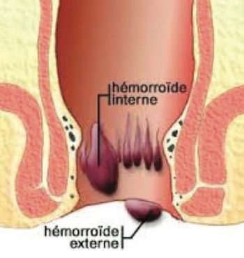 Hémorroïdes - Nouvelle technique THD pour cure chirurgicale des ...