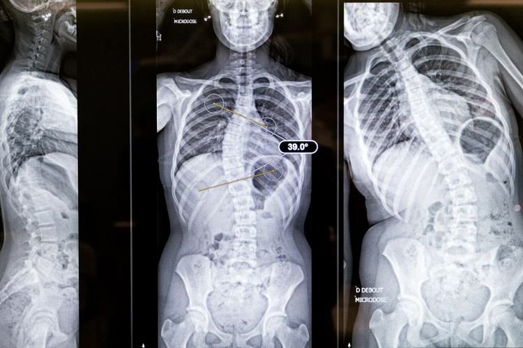 Image radiologique de scoliose