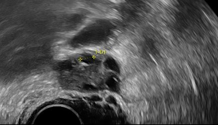 Echographie taille follicule