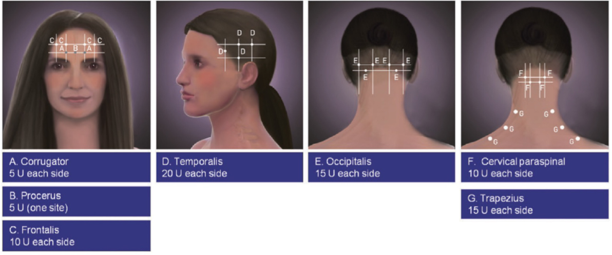 Schémas des zones d'injections du Botox