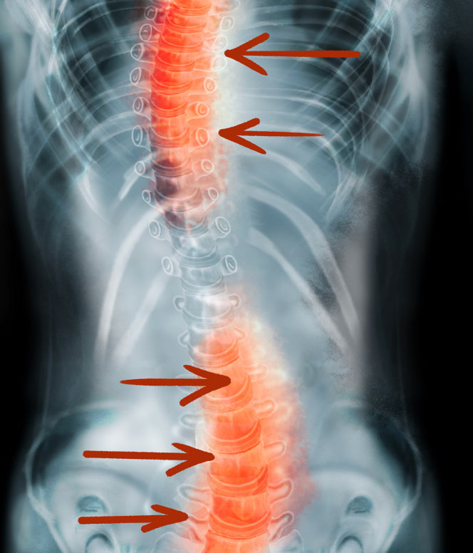 Les déformations vertébrales