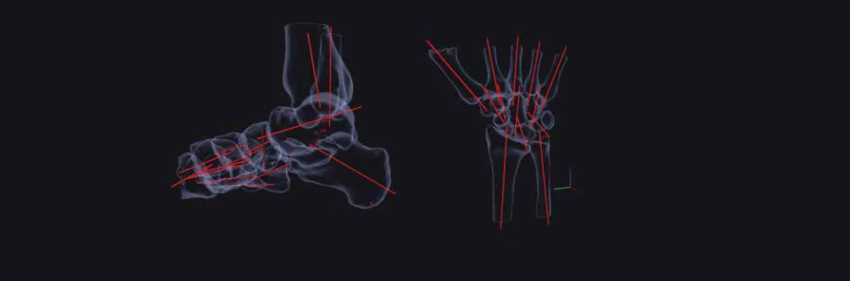 Acquisition d’un scanner permettant un examen en charge sur le site CHL Eich (Cone-beam CT)